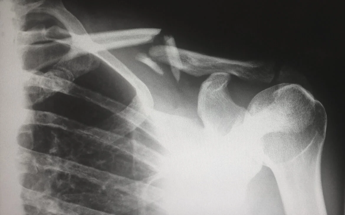 An x-ray of a broken shoulder