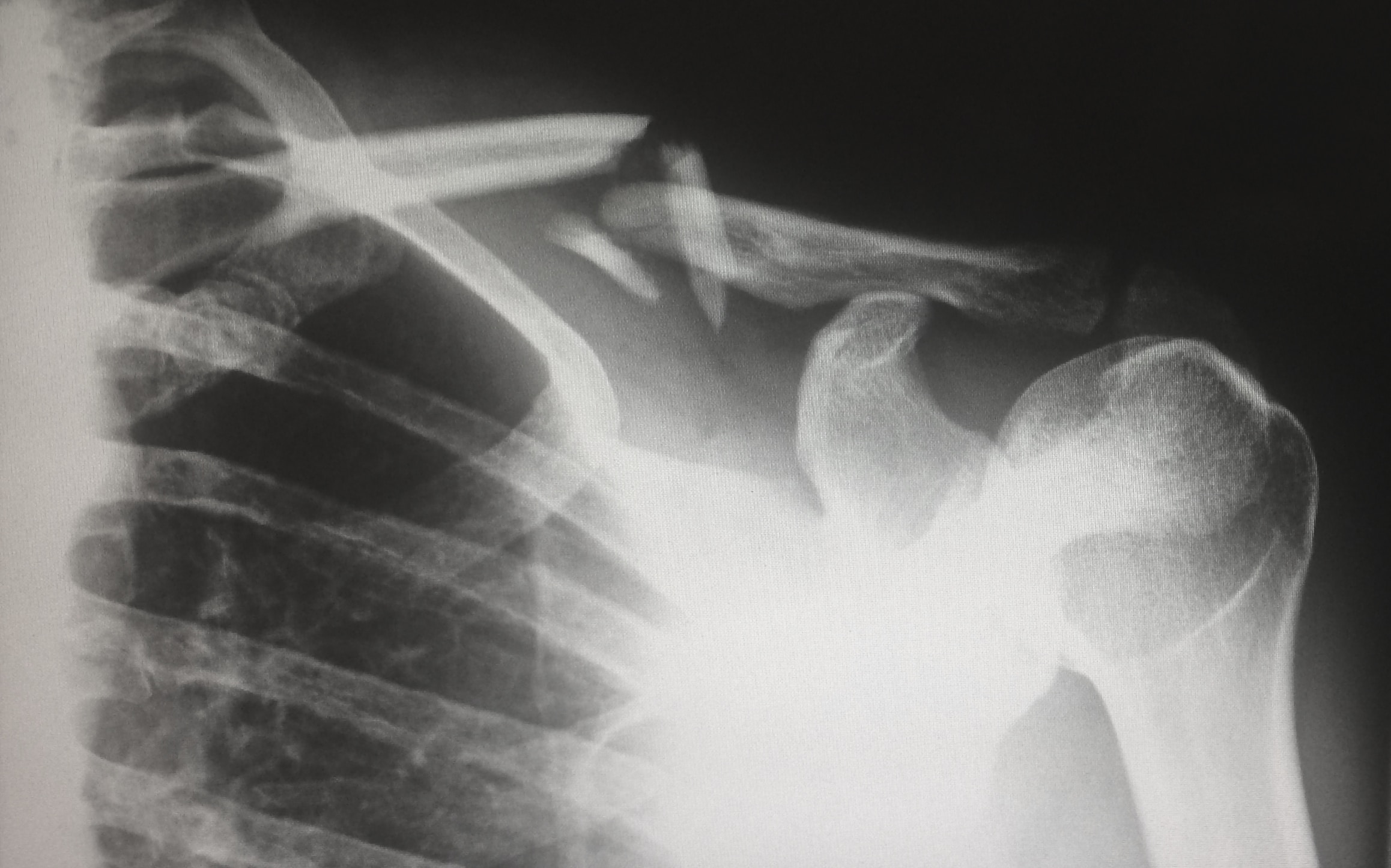 Personal injury claims: x-ray of a broken collarbone